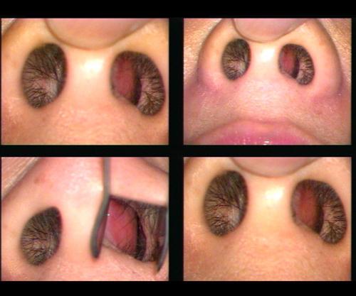 Curvatura del setto nasale: chirurgia e trattamento