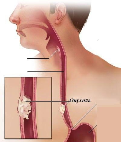 restringimento cicatriziale dell'esofago