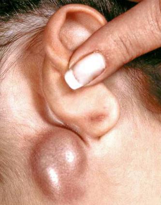 Perché i linfonodi si sono infiammati dietro le orecchie?