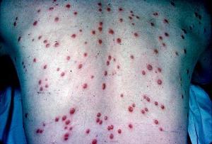 I sintomi della sifilide